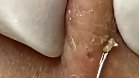 Giants Deep Blackheads, Whiteheads, Big Pimples, Hidden Acne Removal - Best Popping Videos #000004