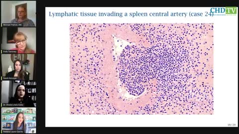 COVID VACCINES: EVIDENCE OF PERSISTENT INFLAMMATION + DEATH IN AUTOPSIES - MICHAEL PALMER, MD