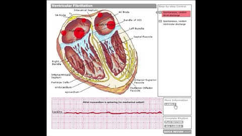 Dr Stanley's ECGcourse.com | Ventricular Fibrillation Tachycardia