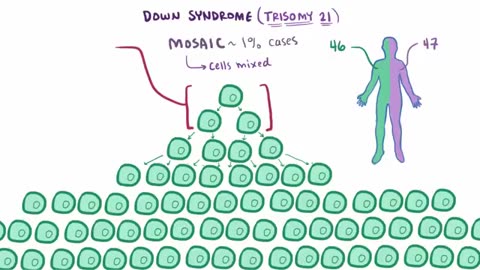 What is Trisomy 21?