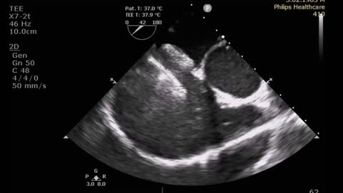 TRANSCATHETER CLOSURE OF MUSCULAR VSD AND MULTIPLE ASD IN AN ADULT: ECHO IMAGES