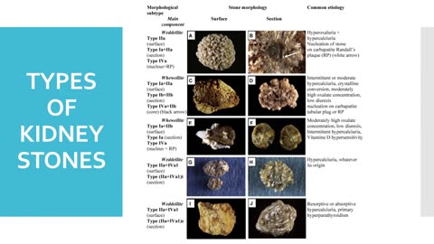 Kidney stones-Cause, symptoms, treatments and prevention