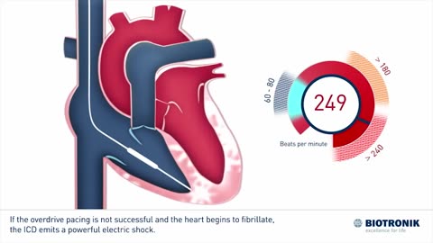 Implantable Cardioverter Defibrillator