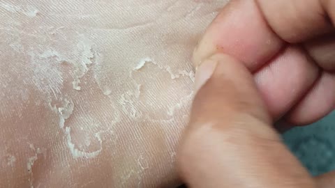 Skin peeling video from feet