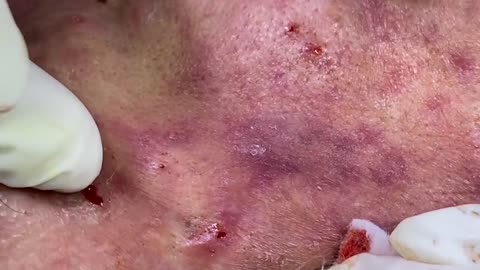 "Giant Cystic Acne & Blackheads Extractions: Satisfying Pimple Popping & Milia Removal!"