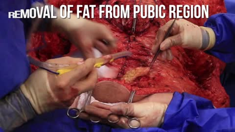 Extended Tummy Tuck and Removal of Mysterious Facial Mass
