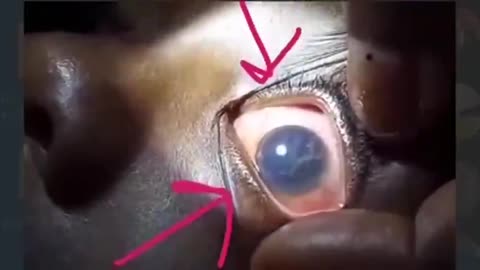 FREAK OUT ALERT - Dr. records Hydra Vulgaris swimming in the eye of an 11yr old vaxxed patient