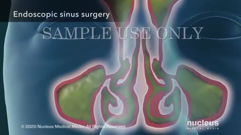 Sinusitis Surgery