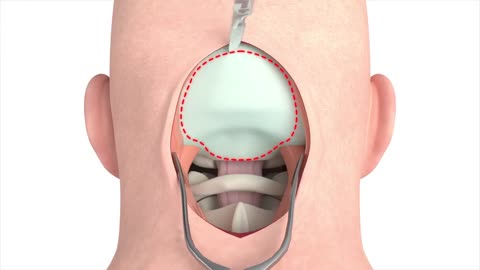 Craniectomy brain surgery - 3D animation