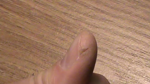 heal finger splits fast