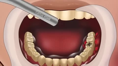 ASMR Dental Treatment for Severe Tooth Decay - Part 1 🦷 #Satisfying #MushroomASMR68