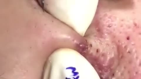 Pimple Popping Acne Treatment Blackhead Extraction