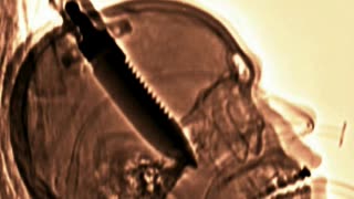 Knife removed from his skull..