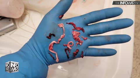 MUST SEE: Mortician Finds Massive Hand-Sized Clots In Cadavers After Vax