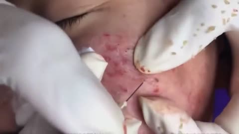 PIMPLE POPPING! Satisfying pimple popping video