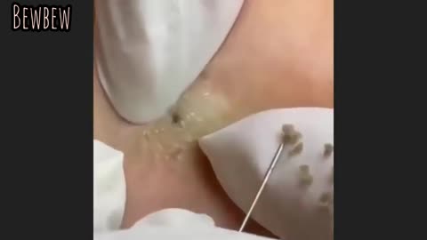 Satisfying pimple popping