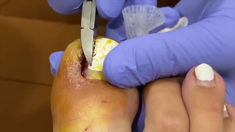 INFECTED INGROWN toenail removal 😱
