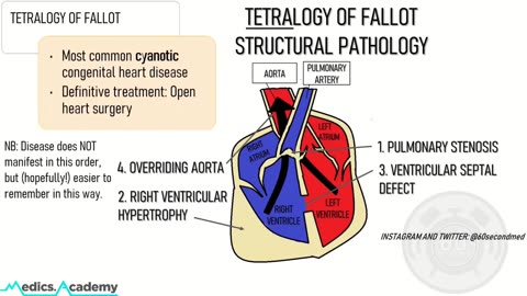 Tetralogy of fallot TOF