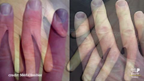 The Mysterious Raynaud's Disease