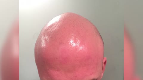 scalp micropigmentation