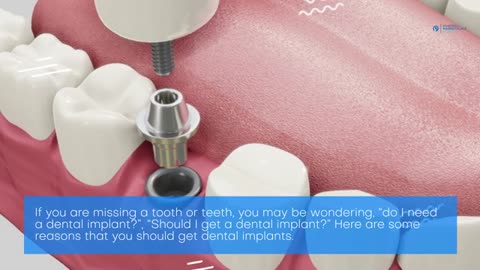 Dental Implants Are A Great Way To Improve Your Self-Esteem