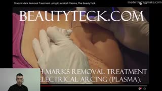 Stretch marks removal using Plasma, the BeautyTeck