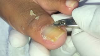 Painful INGROWN TOENAIL Removal.