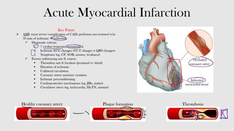 85.Acute Myocardial Infarction