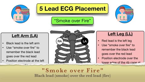 How to Place a 5 Lead ECG_ MNEMONIC [Electrode Placement Made Easy] #nursing