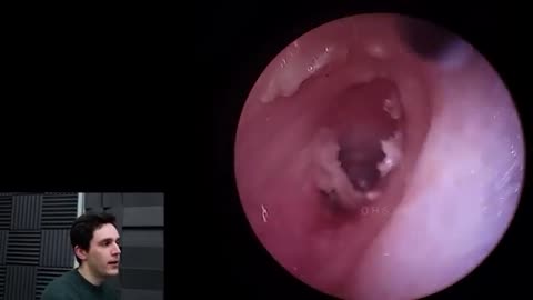 Ear_Infection_Sucked_Out_(New_Endoscope_Test)