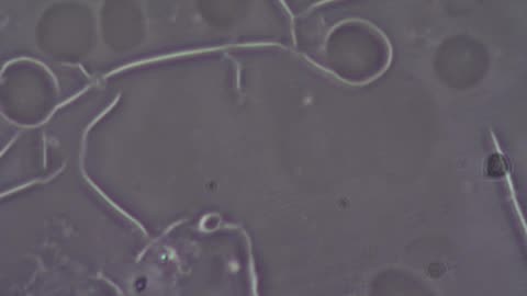 What's Inside The Blood Clots of CV-19 VAXXXed? What is Causing Blood to Clot?