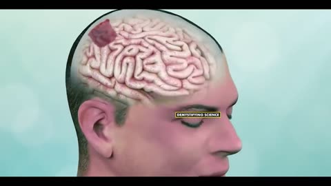 Why Patient Is Awake During This Brain Surgery? (Awake Craniotomy)