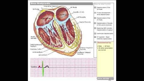 Dr Stanley's ECGcourse.com | Sinus Bradycardia Tutorial