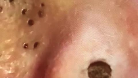 Nasty blackheads in the ear being removed