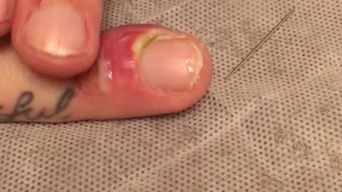 Draining a Fingernail Infection
