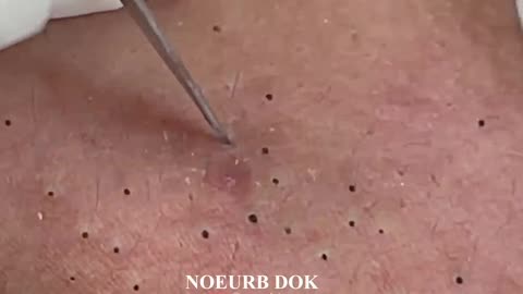 Popping Tons Of Blackheads