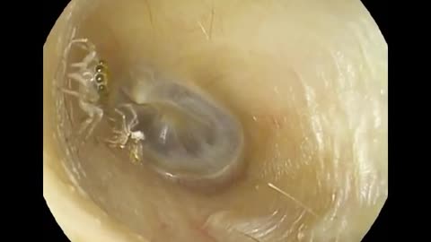 A SPIDER HAS TAKEN UP RESIDENCE IN A WOMAN’S EAR