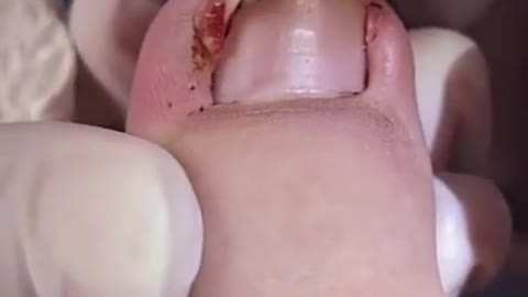 Nail Paronychia Treatment | Nail Clean | Best Nail Clean 2021