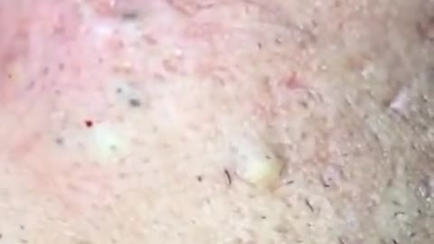 How to remove blackheads from nose, pop pimples, acne treatment #77 #shorts