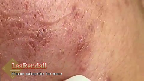 Pimple and ingrown hair _ pimple popping.
