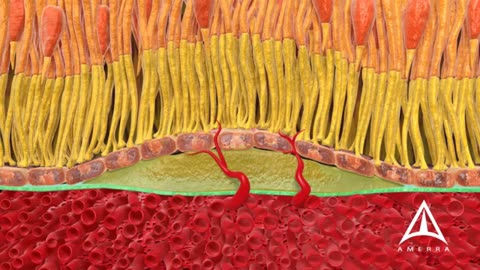 Macular Degeneration Treatment