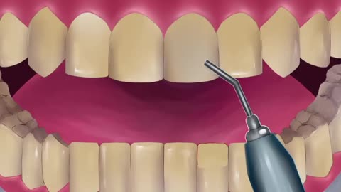 ASMR || Dental ScalingTeeth Animation || Dental Cleaning Stop motion Relaxing
