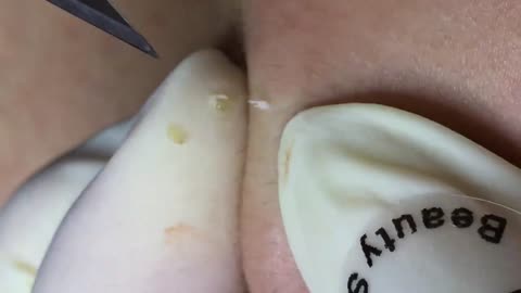 BLACKHEADS REMOVAL|PIMPLE POPPING 2024|BLACKHEAD IN CHEST