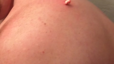 The first Squeeze CYST REMOVAL