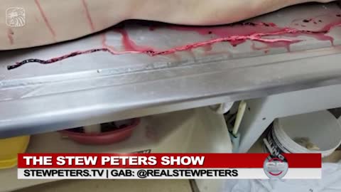Embalmers Discover Horror: Dr Ruby Exclusive: Arteries Filled With Rubbery Clots