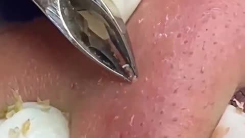 Giants Deep Blackheads, Whiteheads, Big Pimples, Hidden Acne Removal - Best Popping Videos #000015