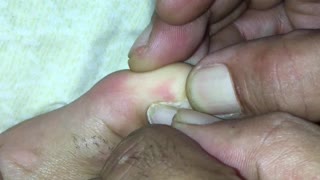 Woman Removes Toenail After it Hollowed Out from Exercise