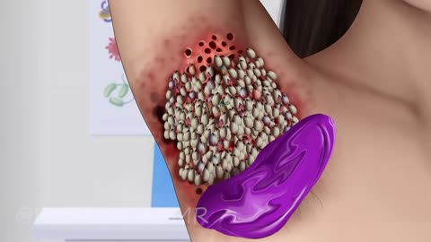 Dog Ticks & Maggot Infected Armpit | Severely Injured Animation