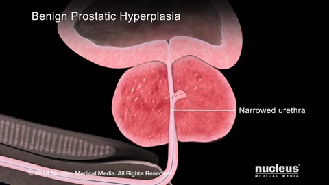 What is Benign Prostatic Hyperplasia (BPH)