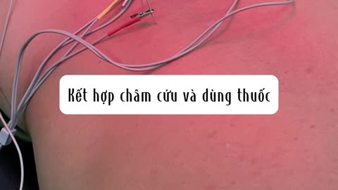 Dịch Vụ Điều Trị Bệnh Bằng Châm Cứu Tại Bác sĩ Võ Thị Hồng Ngọc